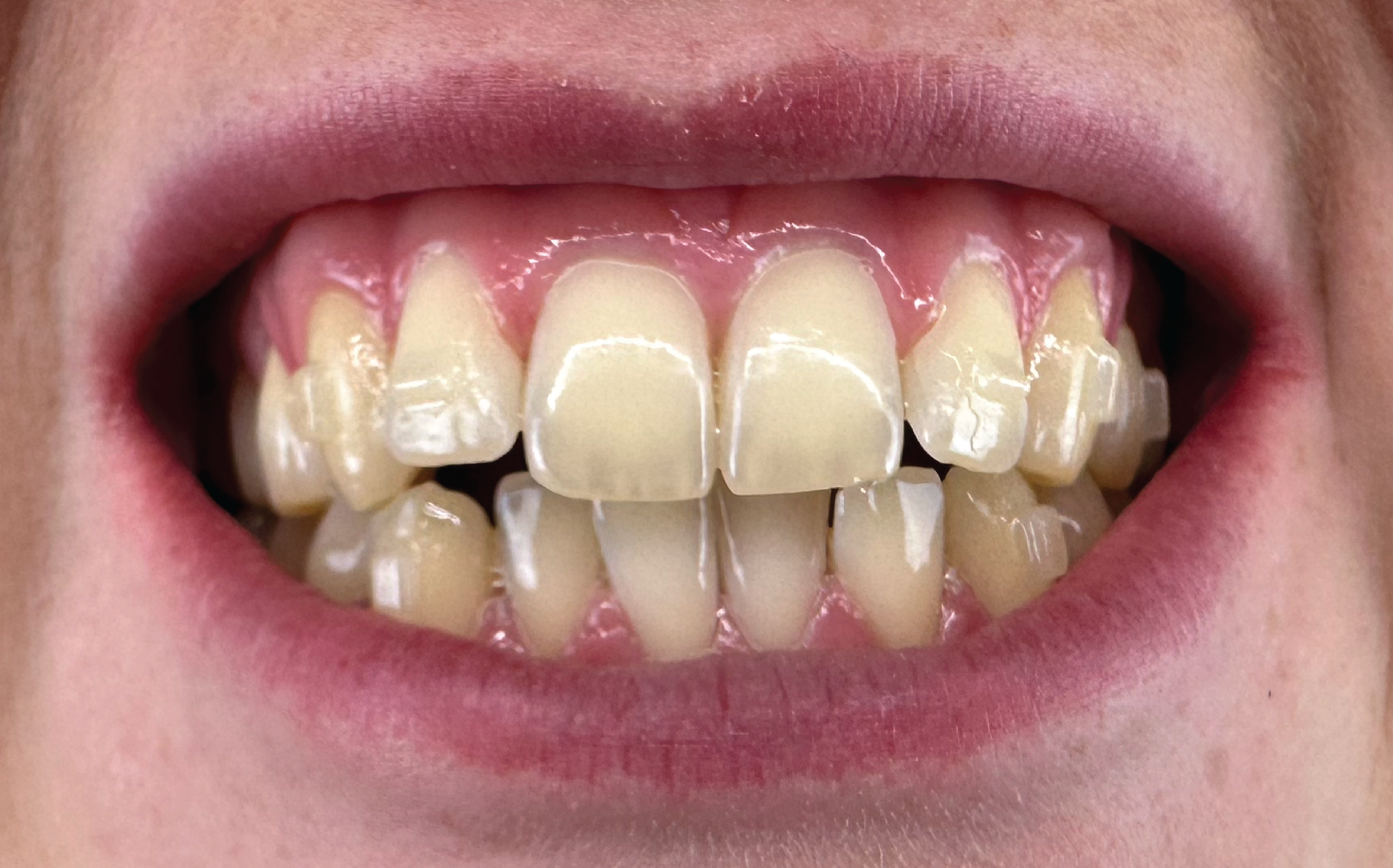 B&A2--13